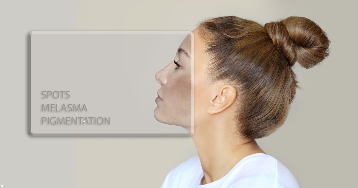 spots, melasma, pigmentation